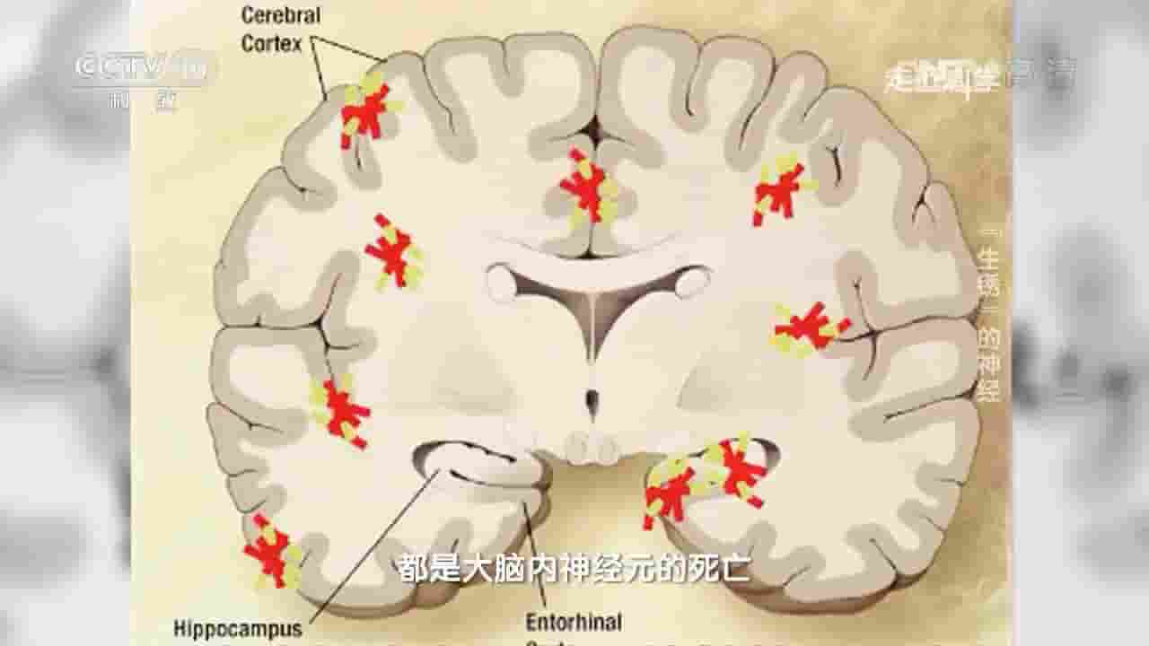 央视纪录片《“生锈”的神经-帕金森病 2017》全1集 国语中字 1080P高清网盘下载