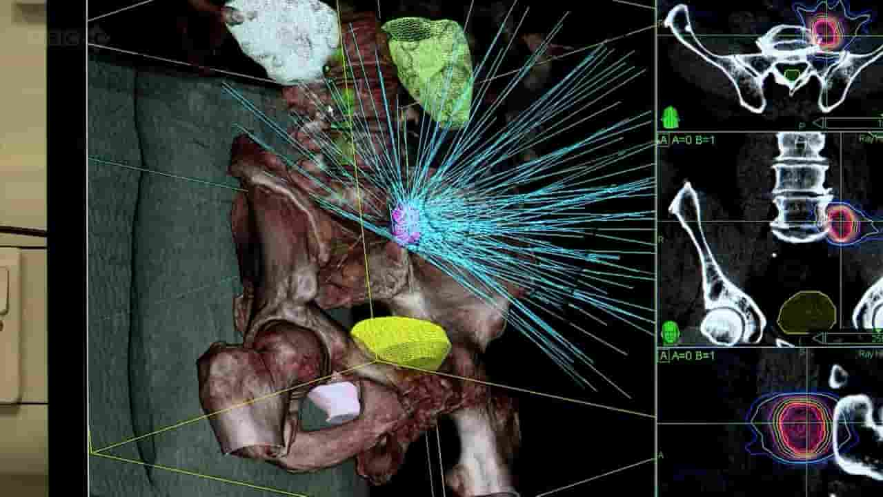 BBC纪录片/地平线系列《攻克癌症/抗癌之路 Defeating Cancer 2012》全1集 英语内嵌中英双字 720P高清网盘